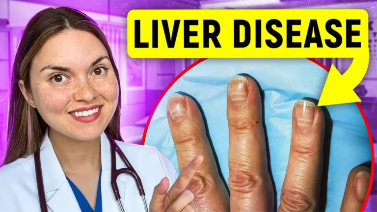नाखून कैसे देते हैं संकेत कि लिवर सही से काम कर रहा है या नहीं?