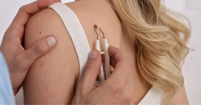 स्किन टैग (Skin Tag) से बचाव के प्रभावी उपाय: जानिए कैसे रखें अपनी त्वचा सुरक्षित