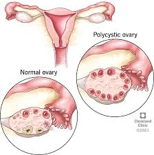 क्या पीसीओएस (PCOS) होने पर प्रेगनेंसी में होती है परेशानी? जानिए संपूर्ण जानकारी